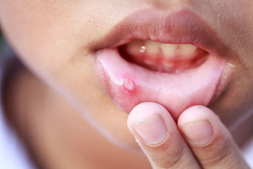Mouth sores may occur during your child’s neuroblastoma treatment.